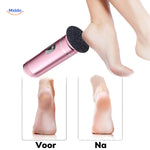 Before and after comparison showing smooth, soft feet results.